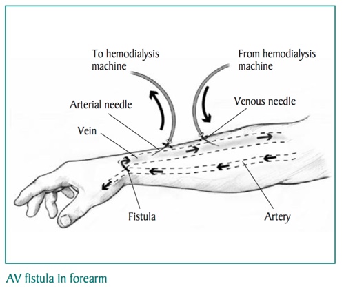 AV Fistula In Forearm